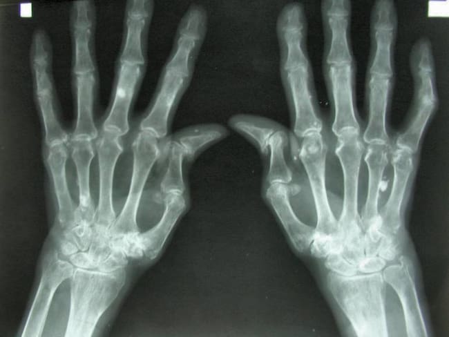 Artritis reumatoide: una de las causas más comunes de discapacidad y pérdida de empleo