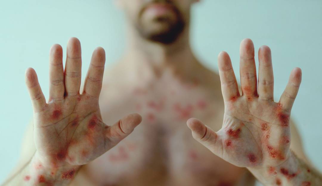 En Colombia se han registrado 273 casos de Viruela del Mono. Foto: Getty Images.