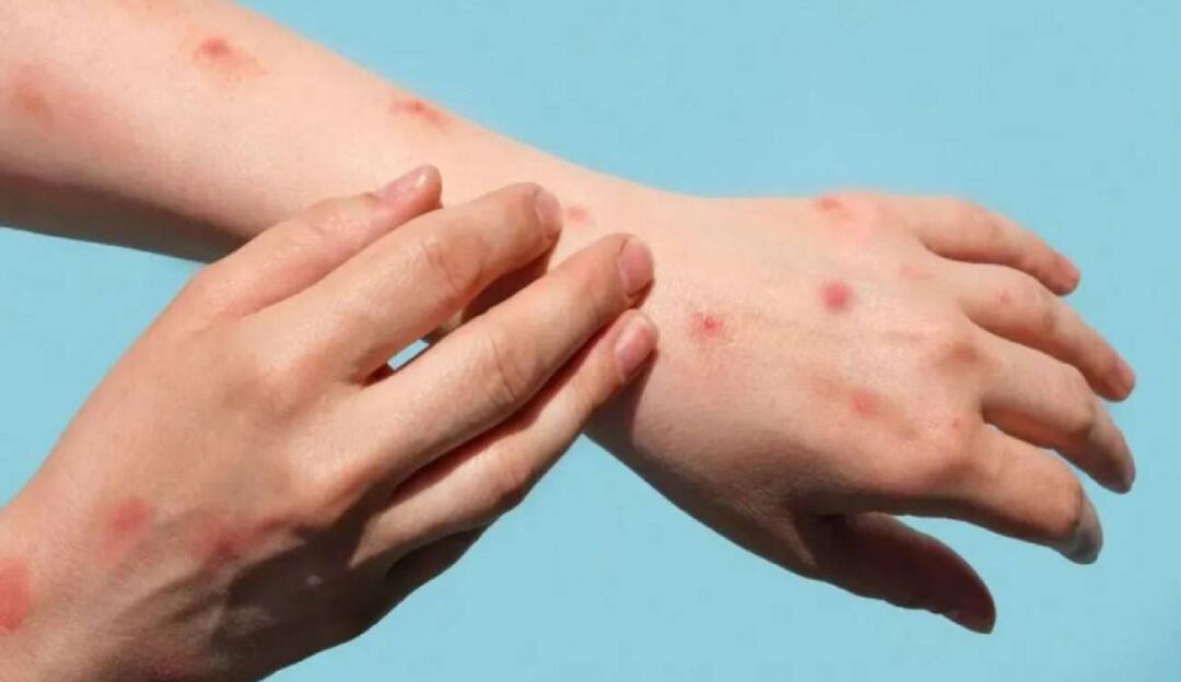 Alerta por viruela del mono