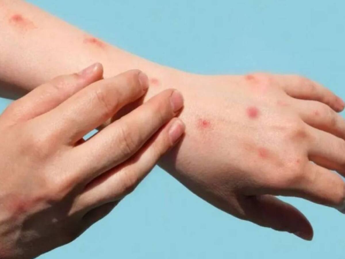 Red pública hospitalaria en alerta por viruela del mono