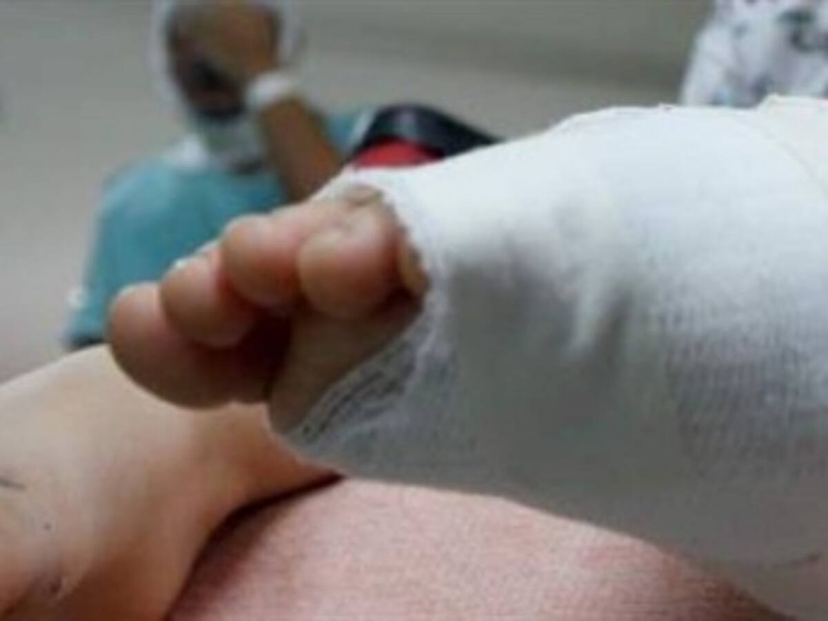 En Caldas son 45 los quemados con pólvora en las tres últimas semanas