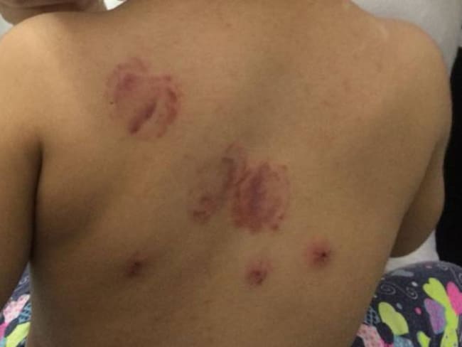Atacada a mordiscos niña de dos años en Palmira
