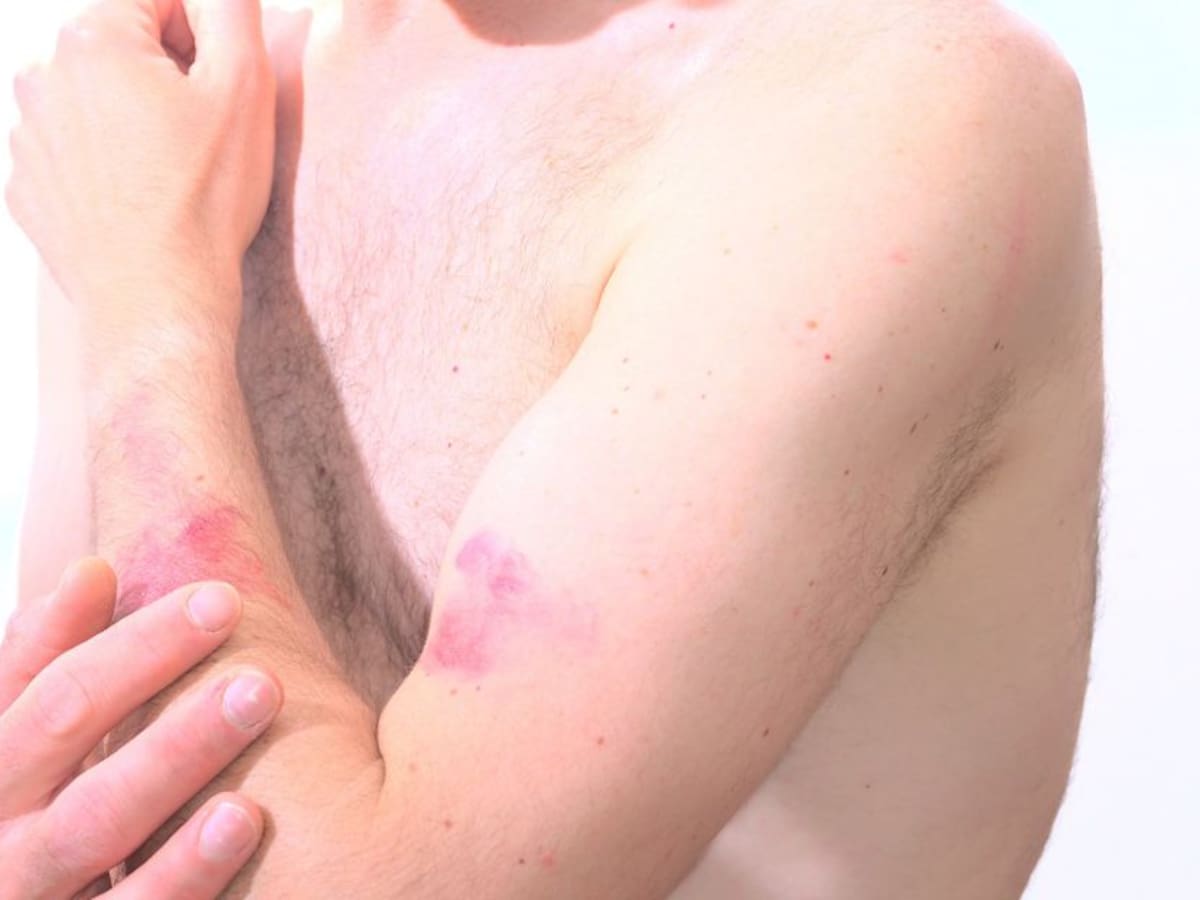 ¿Cómo saber si tengo viruela del mono u otra enfermedad de la piel?