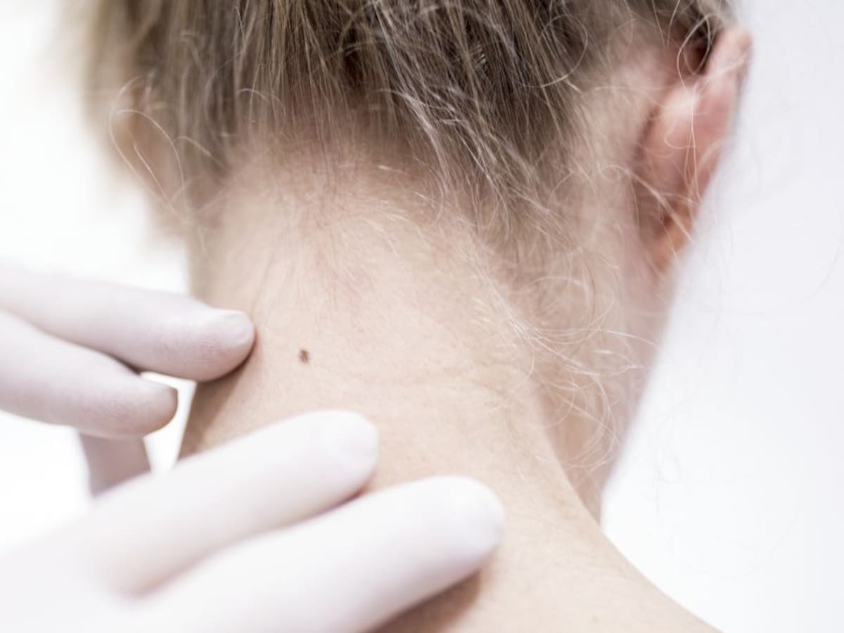 ¿Cuáles son las señales de alerta para detectar el cáncer de piel?