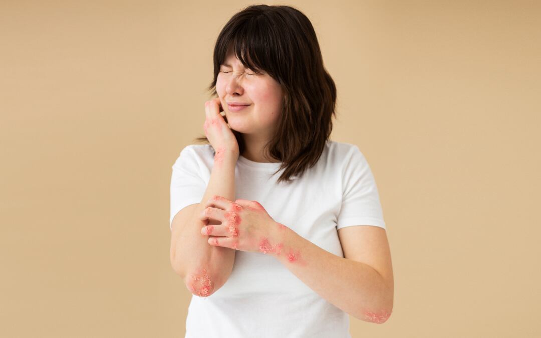 ¿Cómo afecta el estrés a la piel? Síntomas, tratamiento y prevención