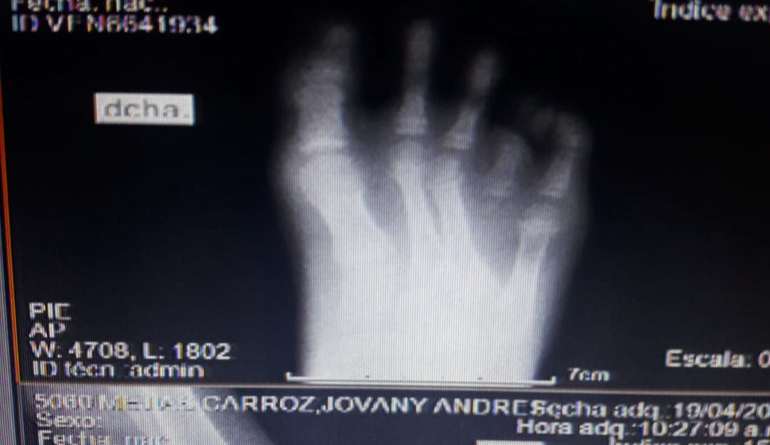 El menor de seis años presenta una celulitis en su pie derecho desde octubre de 2020 tras sufrir un golpe con objeto contundente en Cartagena