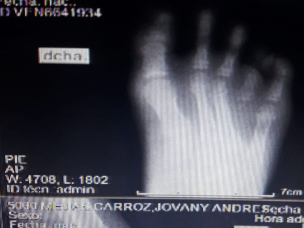 Niño a punto de perder segundo dedo de su pie por demora en atención