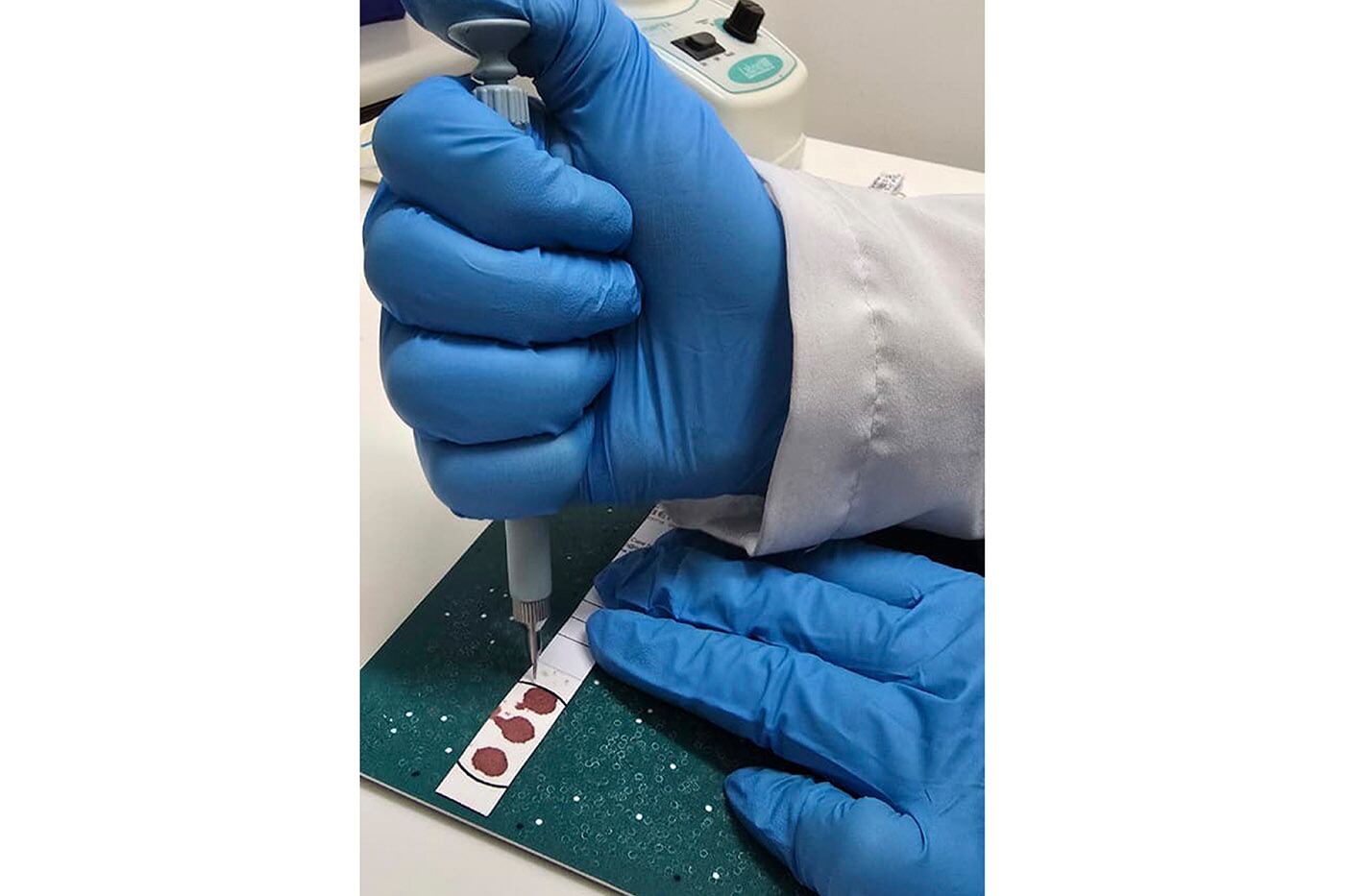 El equipo logró diagnosticar trastornos nunca antes documentados en Colombia, como el síndrome de Zellweger, Hermansky-Pudlak tipo 6.