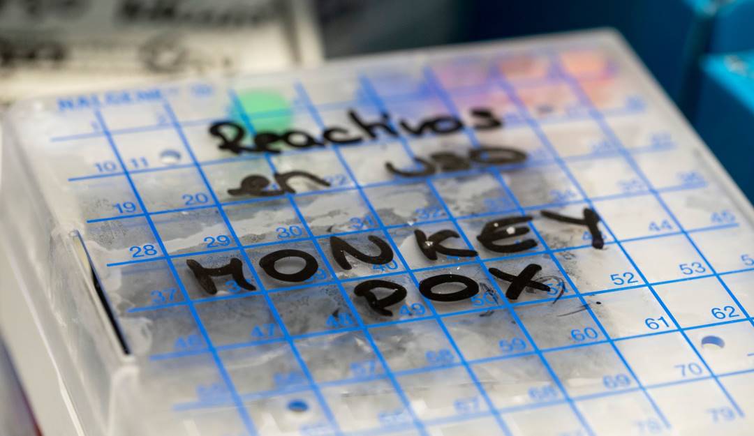 Pruebas para sospechas de viruela del mono. Foto: Getty