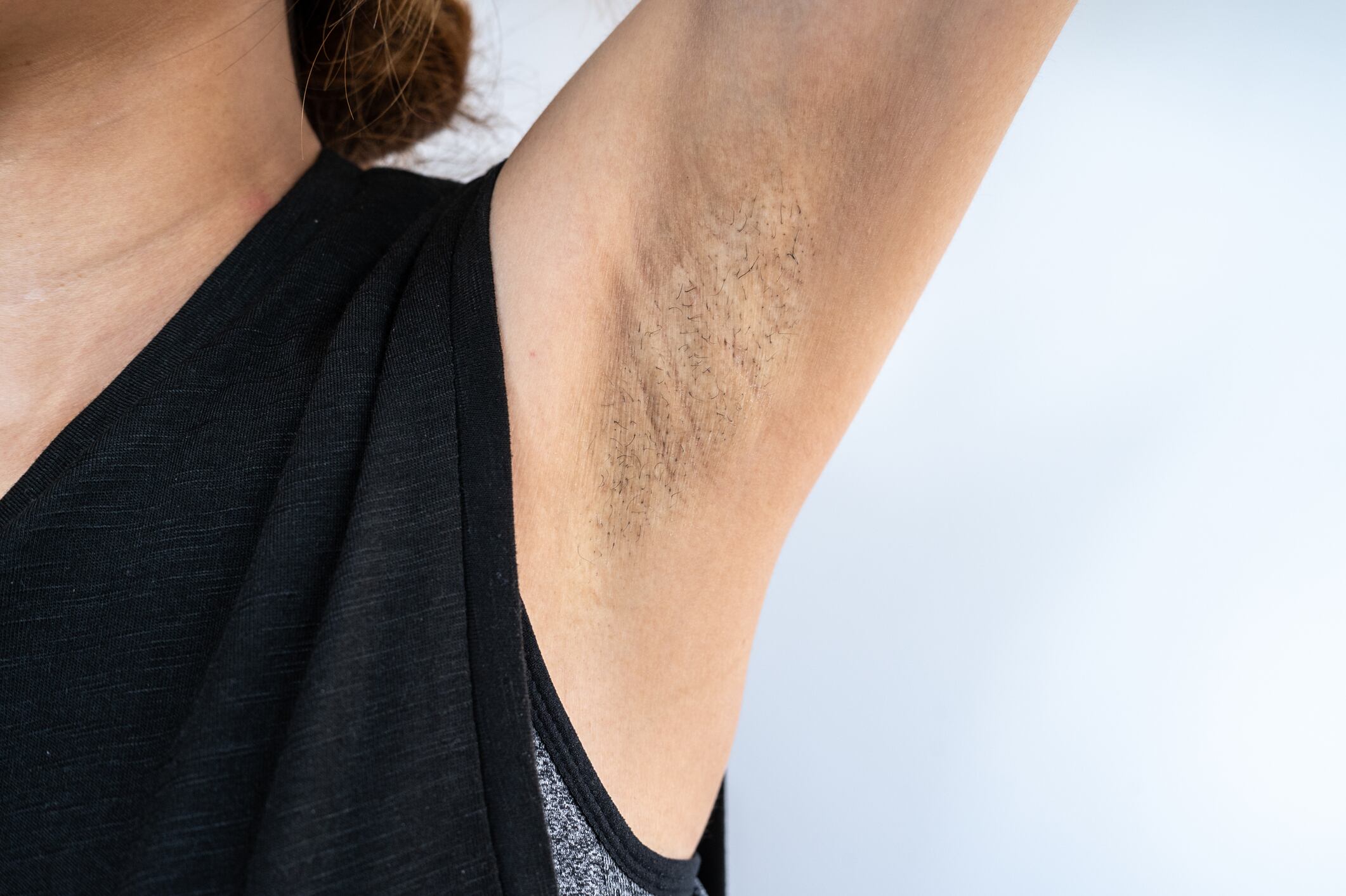 Mujer mostrando su axila manchada // Foto de referencia: Getty Images