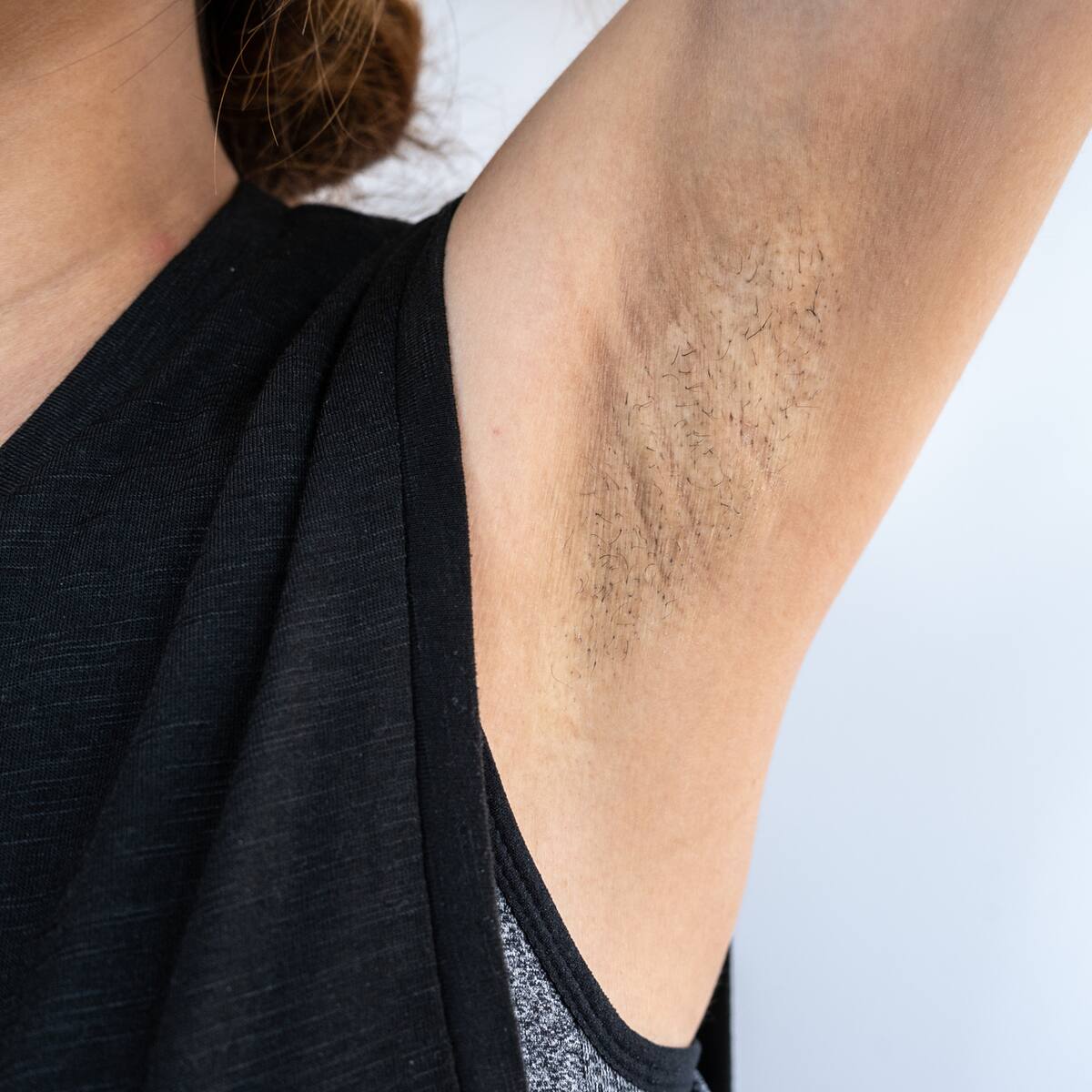 ¿Cómo aclarar las axilas y por qué se manchan? Dermatólogos responden