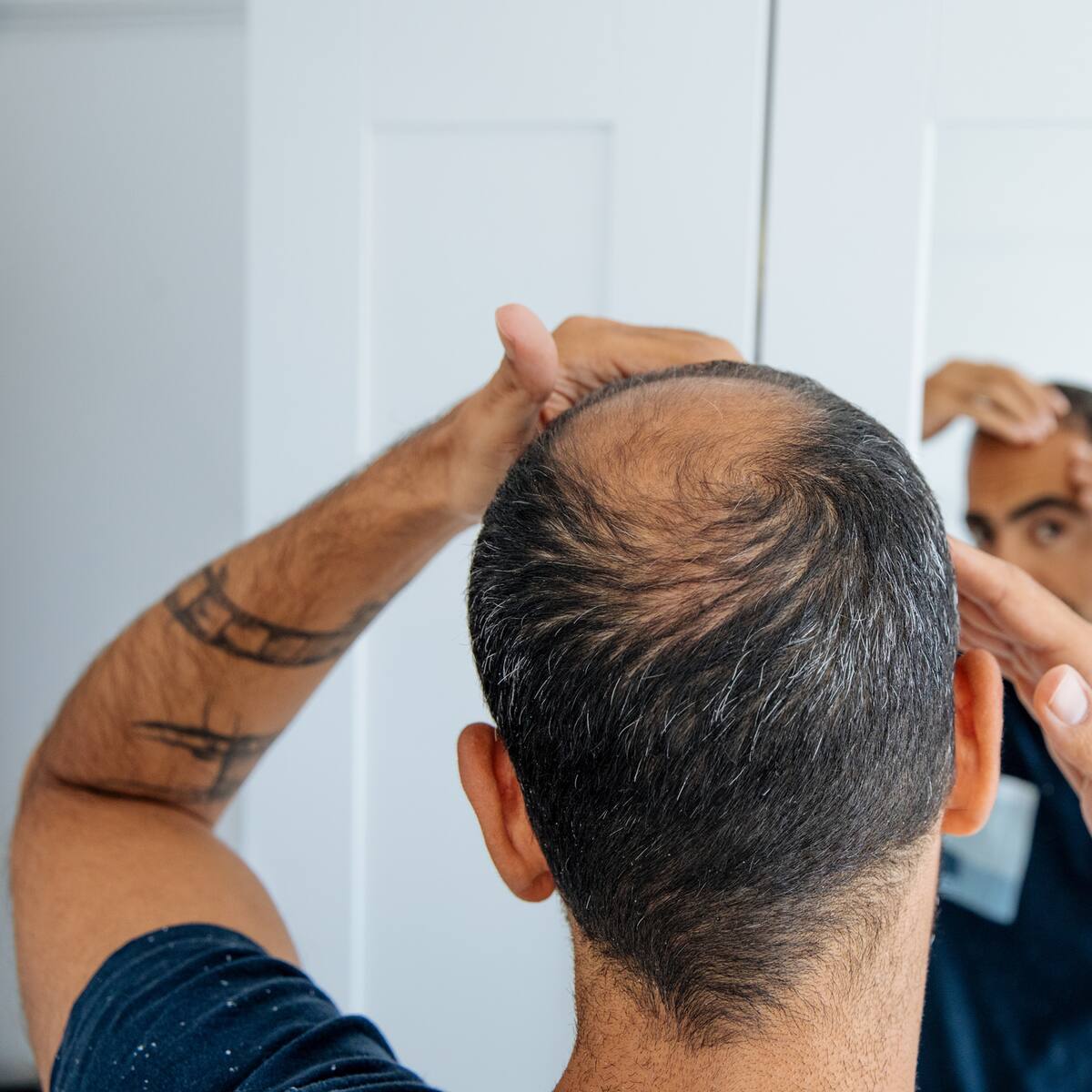 ¡Ojo! INVIMA alerta por venta ilegal de cápsulas para evitar la calvicie