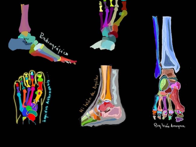 El Ortopedista Antioqueño que Transforma Huesos en Obras de Arte
