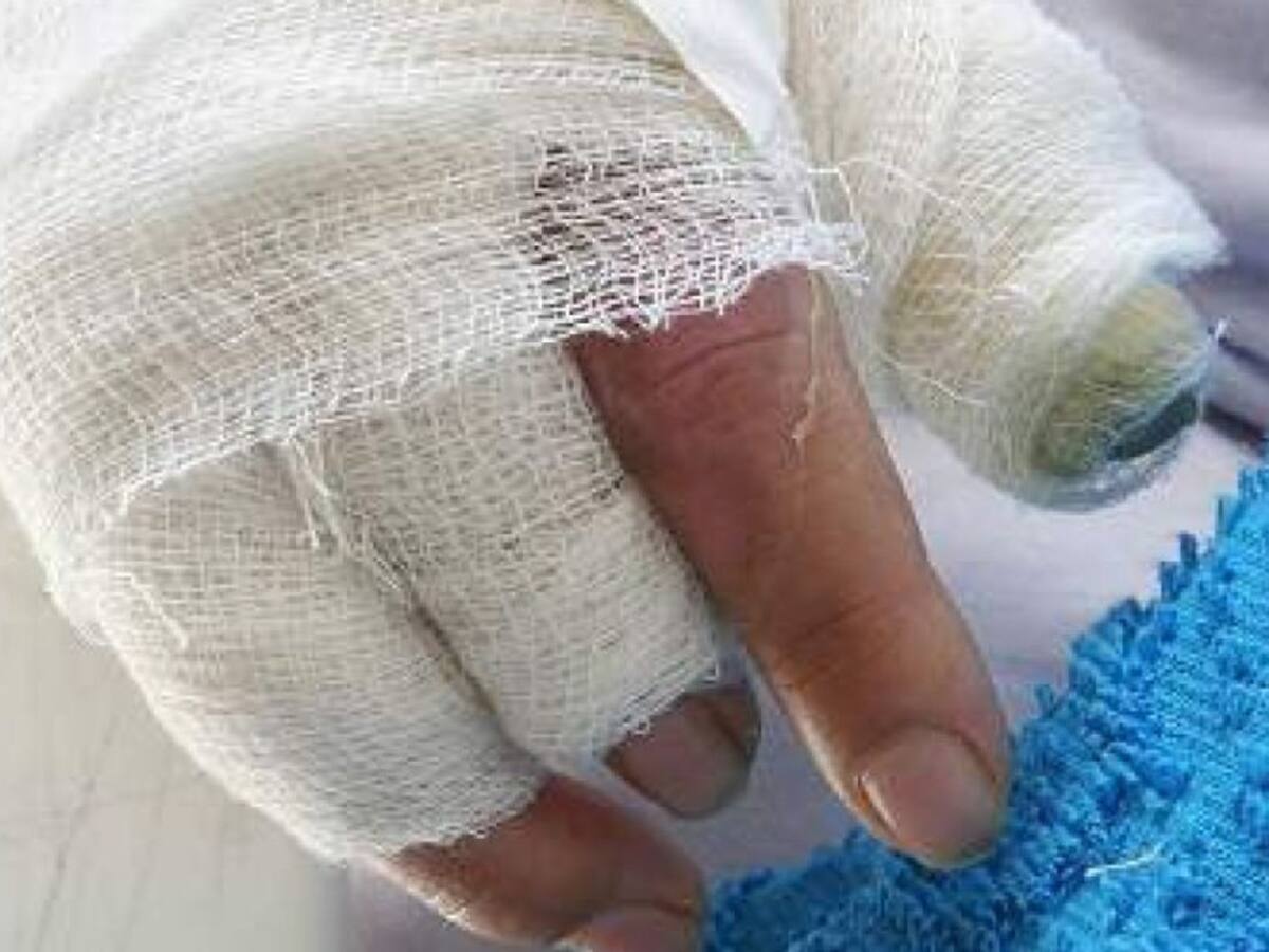 A pocos días de la navidad ya se tienes tres quemados con pólvora en Caldas