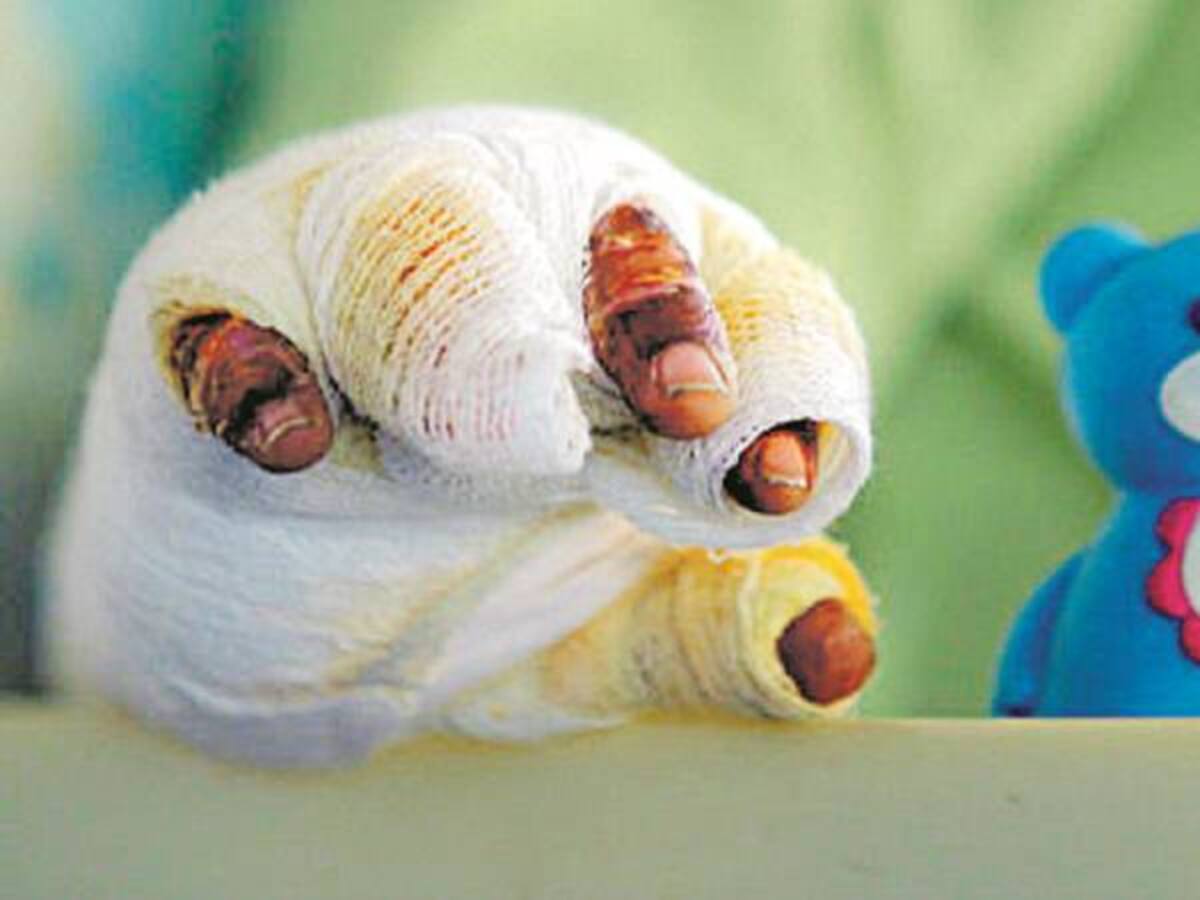 Van 34 personas quemadas en el Valle durante la primera mitad de Diciembre