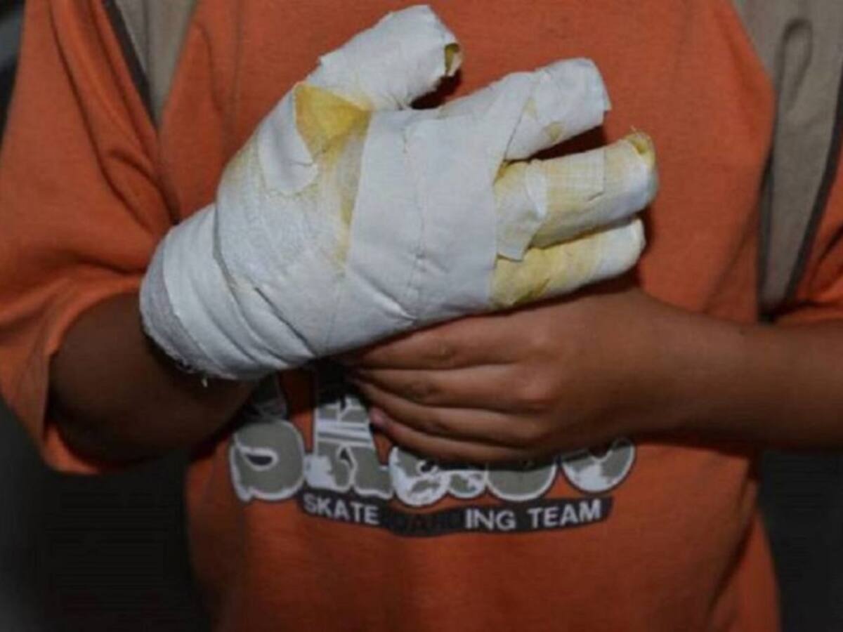 Menor quemado con pólvora en Palmira, podría perder su mano izquierda