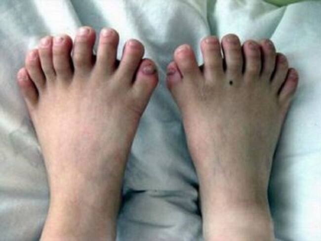 El único laboratorio para enfermedades raras del suroccidente se inauguró en Cali