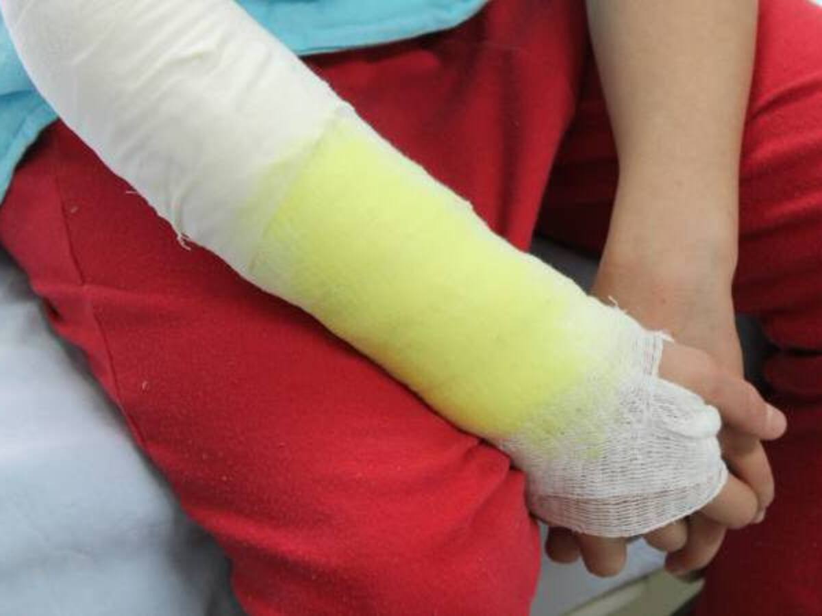 ¿Cuántos menores de edad han resultado quemados con pólvora en Armenia?