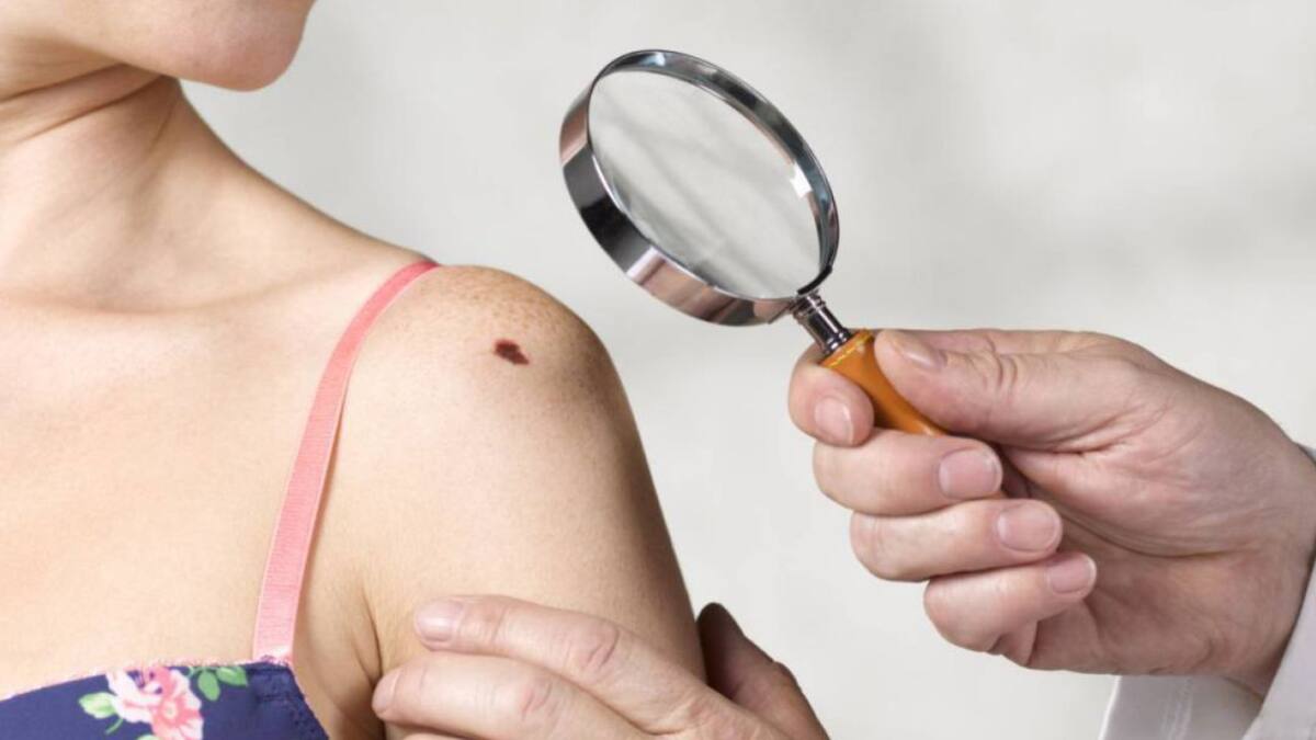 Aumentan los casos de cáncer de piel en Risaralda