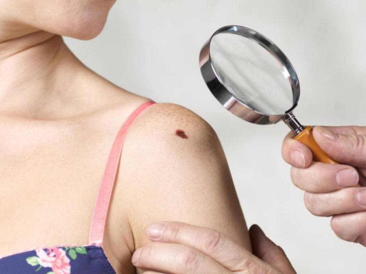 Aumentan los casos de cáncer de piel en Risaralda