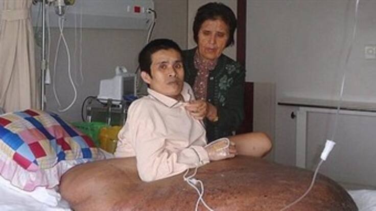 Operan a un vietnamita con un tumor de 90 kilos en su pierna