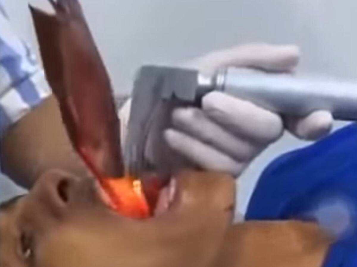 Un hombre se tragó un pez vivo en Pivijay, Magdalena y casi muere ahogado