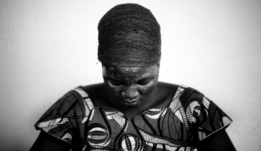 Paciente contagiada por la viruela del mono. 