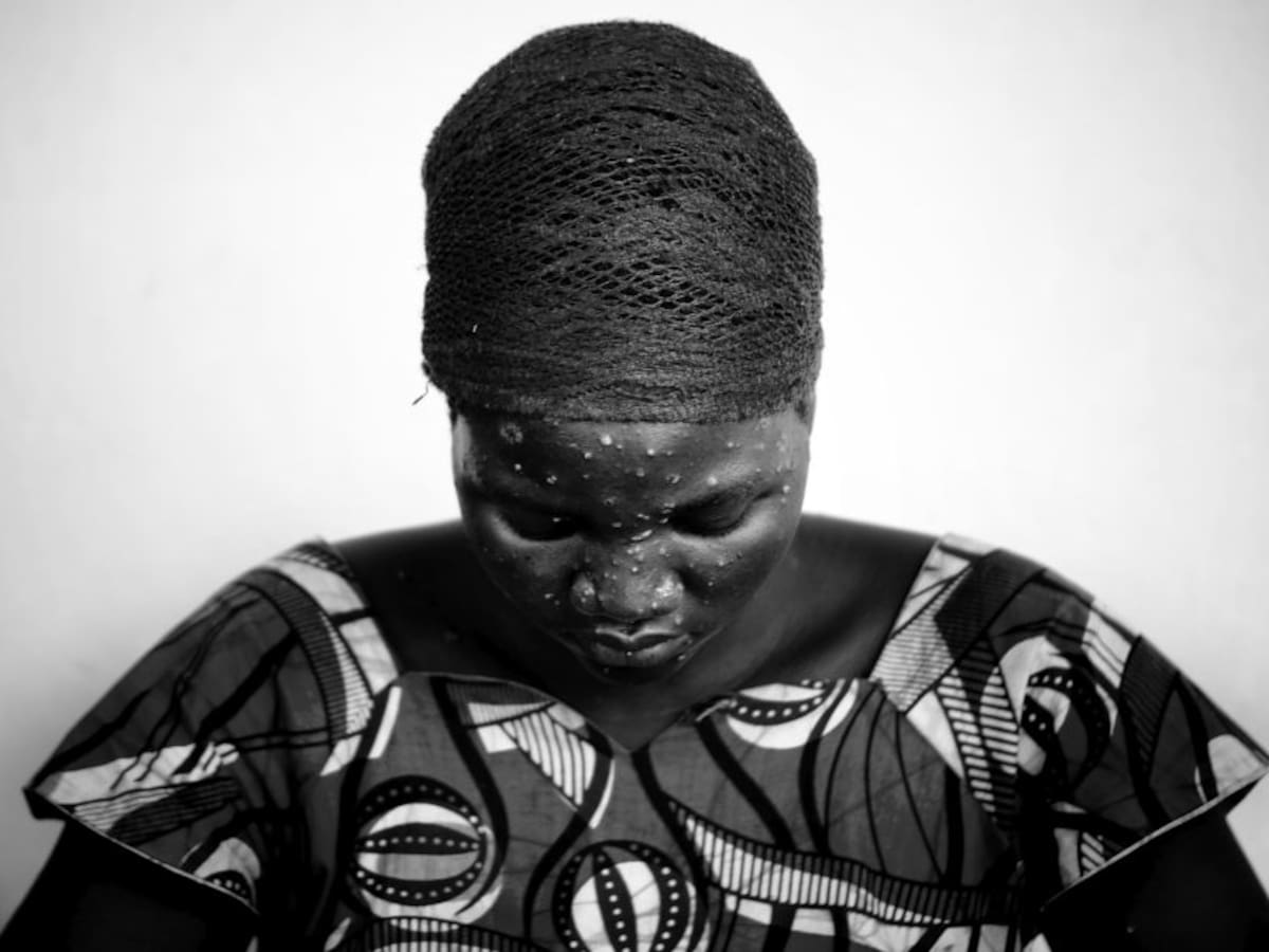 Ya son más de 700 casos de viruela del mono a nivel glogal, 21 en EE.UU.