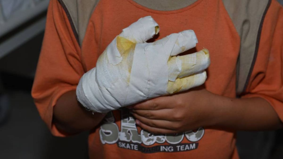 Reportan nueve quemados con pólvora en el Magdalena