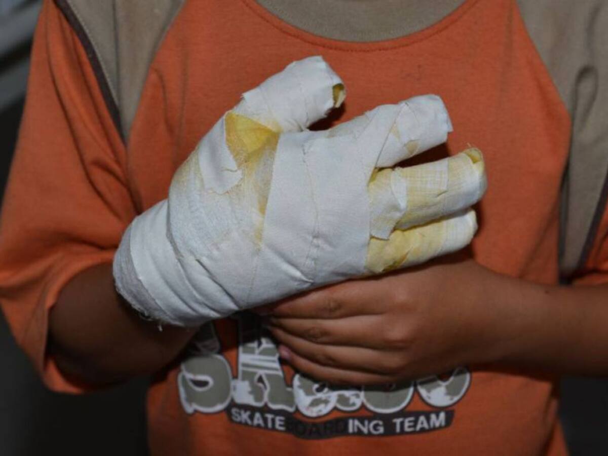 Reportan nueve quemados con pólvora en el Magdalena