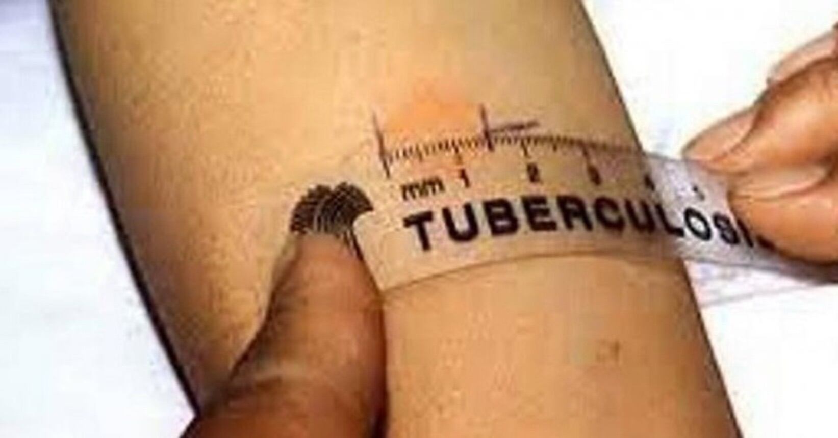 Aumentan casos de tuberculosis en cárcel de hombres de Pereira / Foto: Colprensa