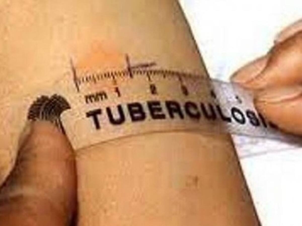 Aumento de casos de Tuberculosis en Nariño.