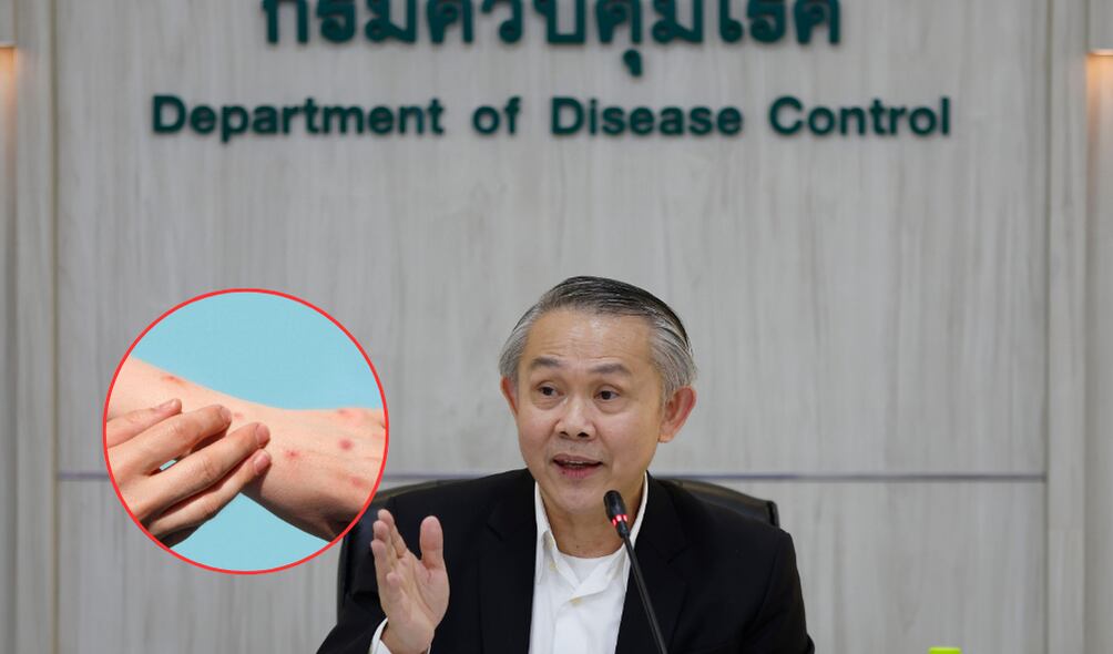 Tailandia alerta posible caso de mpox en el país. ( Foto: EFE / Getty / Caracol Radio )