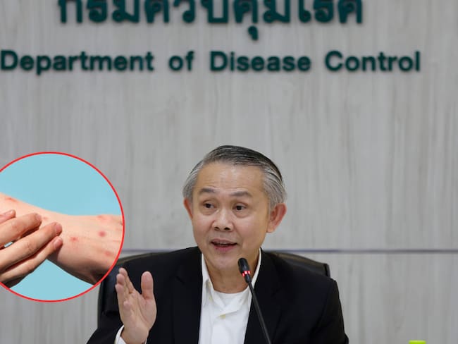 Tailandia alerta posible caso de mpox en el país. ( Foto: EFE / Getty / Caracol Radio )