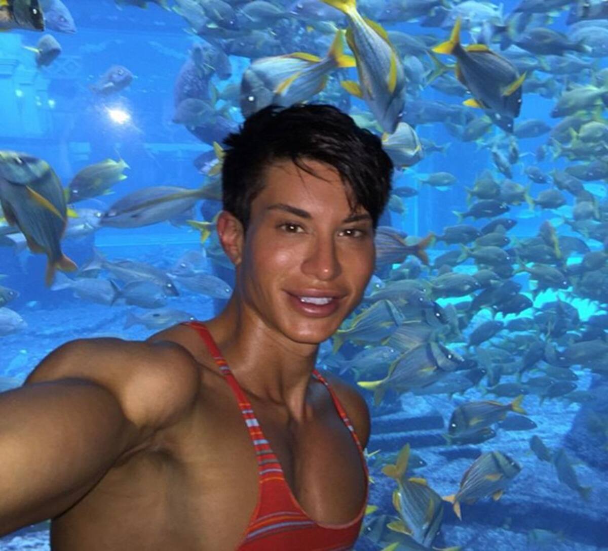 Justin Jedlica se operó para remover tres venas de su frente, intervención que lo pudo dejar ciego. Fotos: Instagram.
