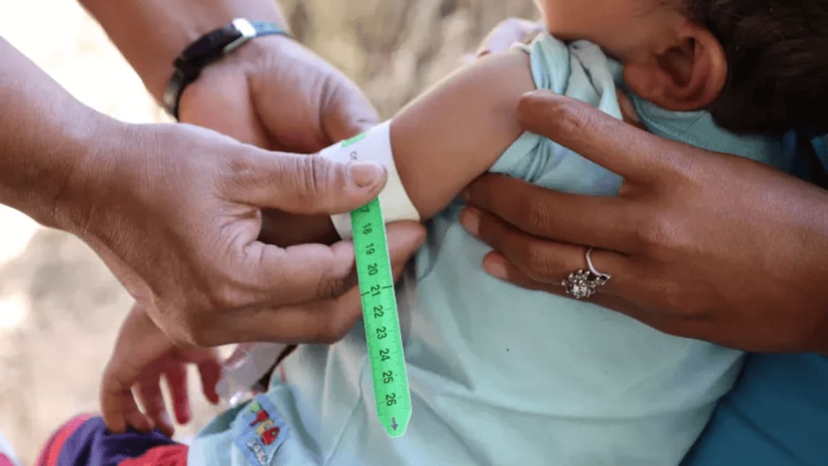 Alarma en el Huila por fallecimiento infantil asociado a desnutrición