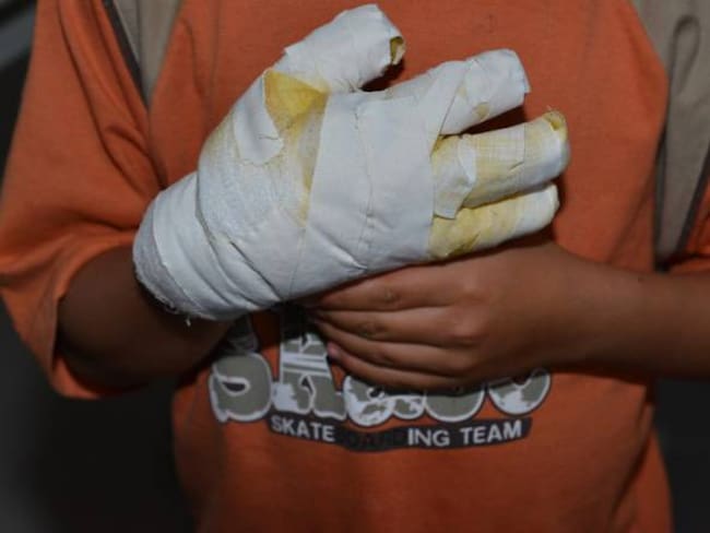 Van dos niños y cuatro adultos quemados con pólvora en las fiestas decembrinas en Boyacá