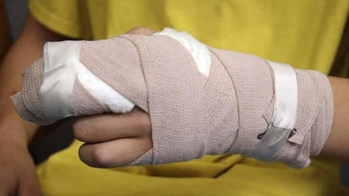 Ya son cuatro los quemados con pólvora en Ibagué