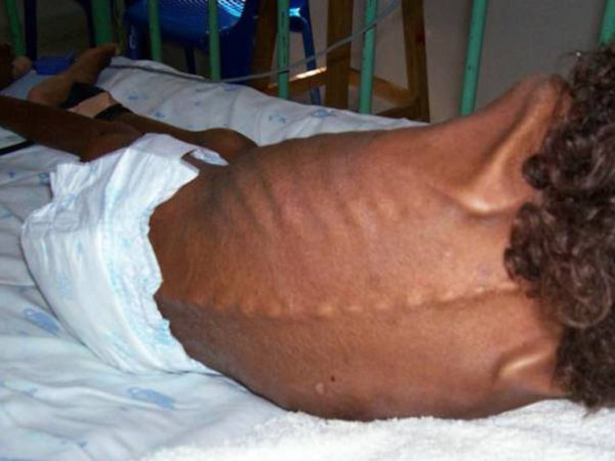 El DPS iniciará la detección de niños con desnutrición en todo el país