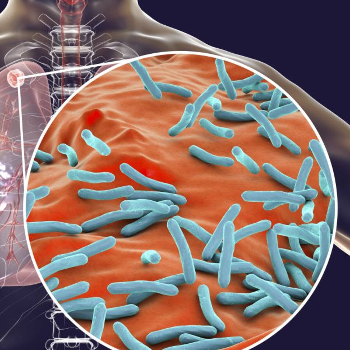 24 de marzo, Día mundial de la tuberculosis