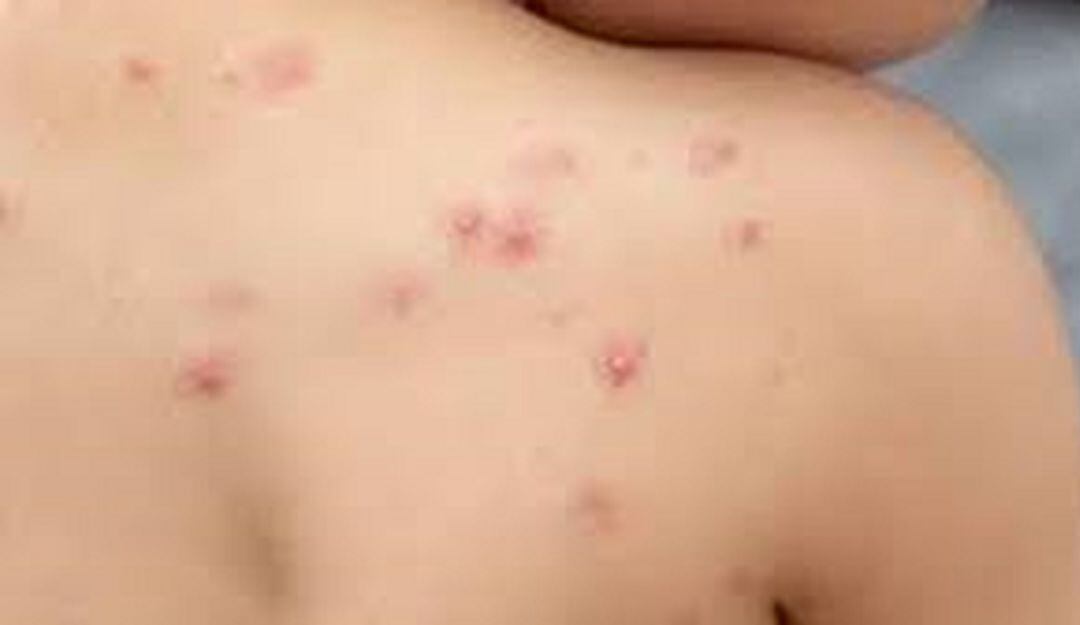 Cuatro casos positivos de la viruela del mono en Ibagué