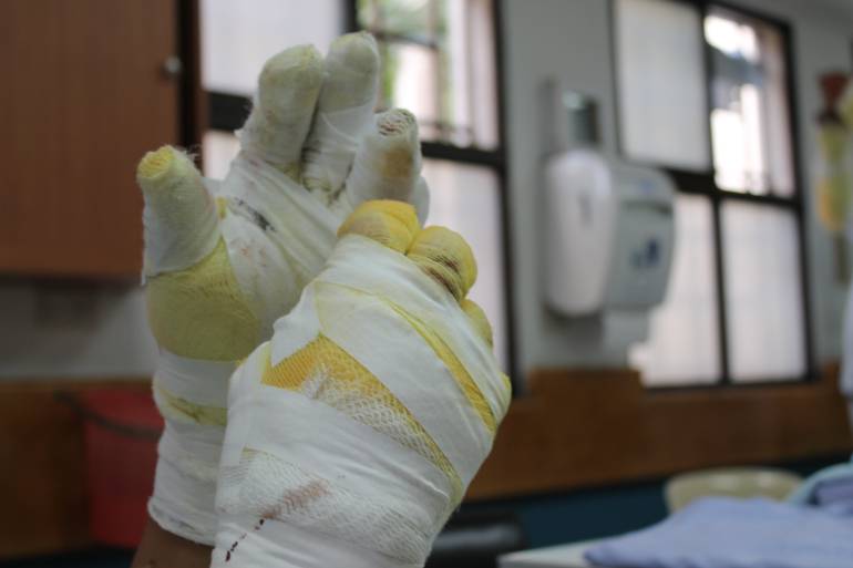 Quemados con pólvora en Antioquia. 