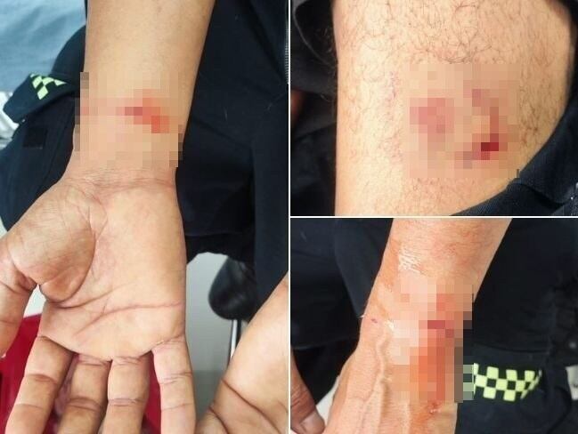 Lesiones que le ocasionó un perro de raza pitbull a un uniformado en medio de un operativo policial en Manizales. Fotos suministradas.