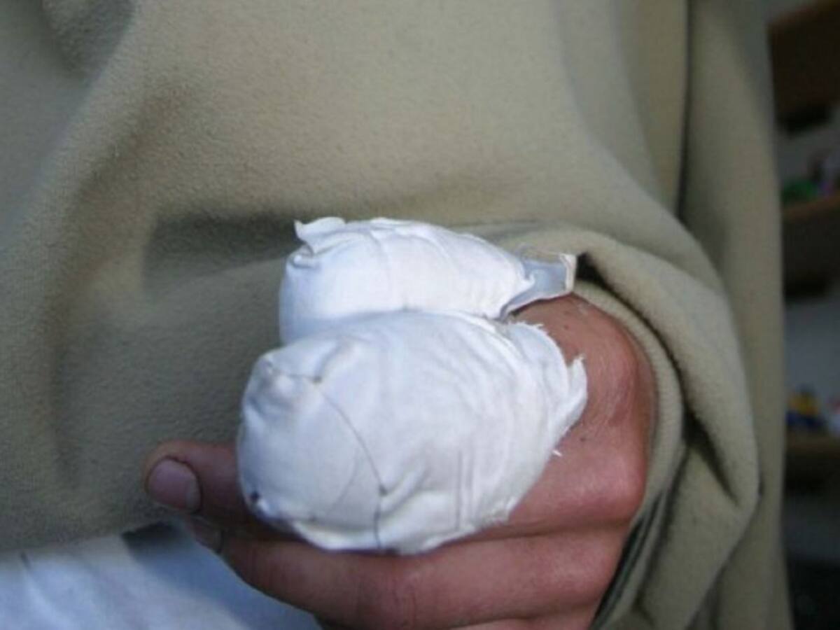 Menor de 11 años se quemó tras manipular una pepeleta en Remedios