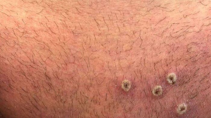 De los casos confirmados 5 son hombres y 1 mujer, donde el rango de edad más afectado es entre los 18 y 49 años.