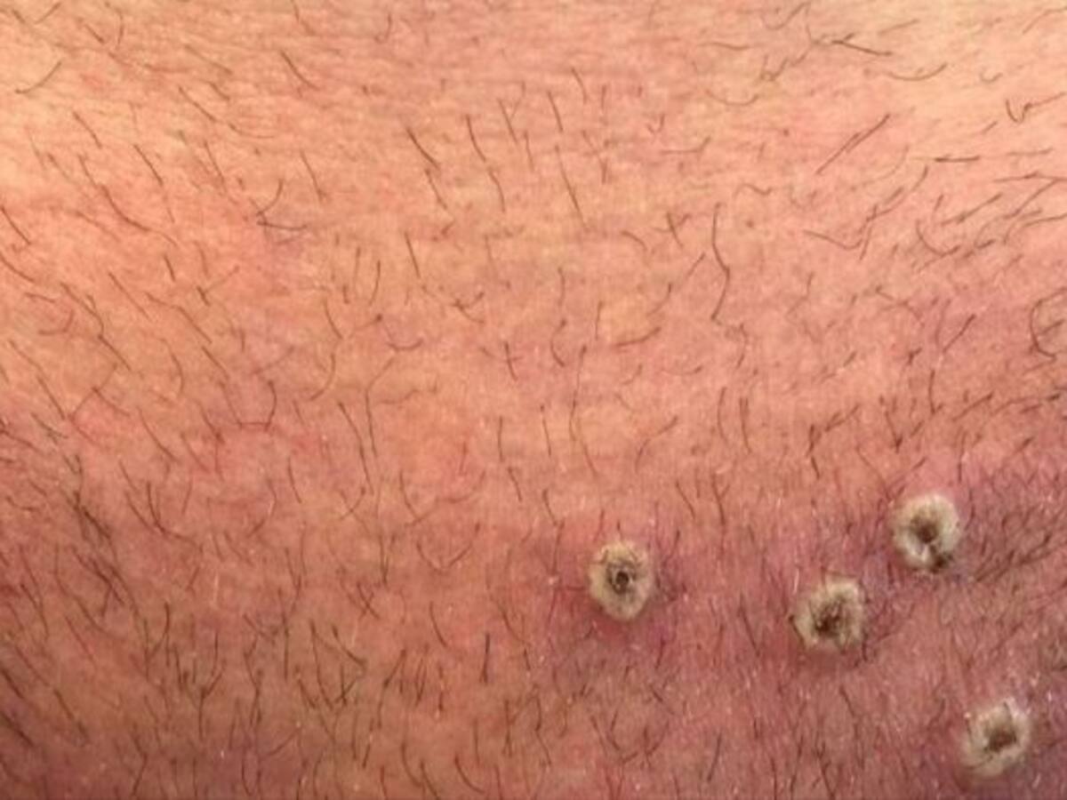 ¿Cuántos casos reporta el Huila de Viruela Símica?