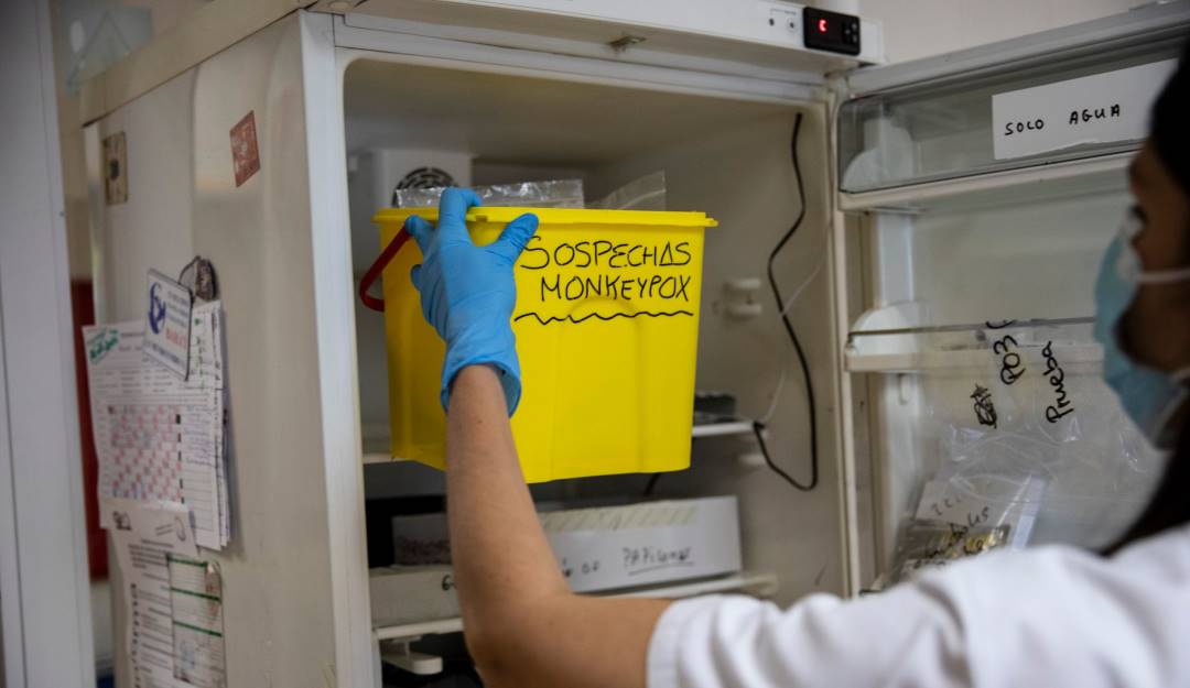 Pruebas para la detección de la viruela del mono. Foto: Getty