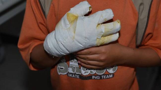 Niño quemado.