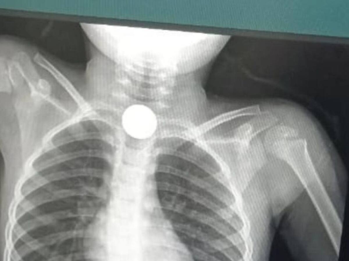 Un niño se traga dos monedas y su familia denuncia no atención médica