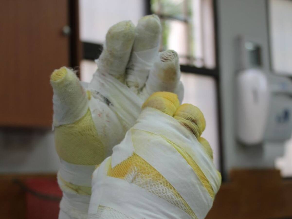 Diciembre y Año Nuevo cerraron con 65 quemados con pólvora en Antioquia